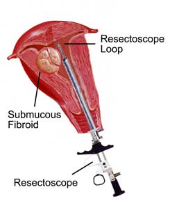 hysteroscopic resection of fibroids dubai